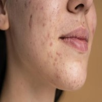 acne scar treatment in Hyderabad 